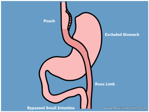 gastric-bypass-for-mexico-health
