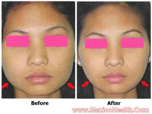 cosmetic-surgery-in-tijuana-mandible-angle-reduction