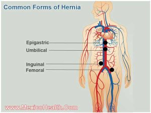 hernia-surgery-1