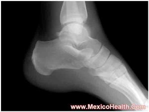 ankle-bone-grafting