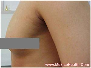 breast-reduction-in-tijuana-mexico