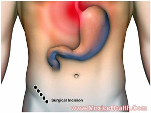appendectomy-mexico