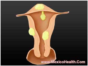fibroid-tumors-surgery-fibroid-tumors-surgery-mexico