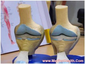 knee-replacement-mexico
