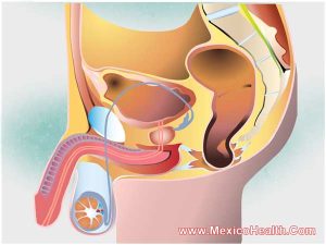 buccal-mucosal-urethroplasty