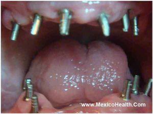 mini-dental-implants-cancun-mexico