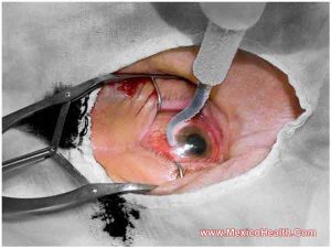 eye-surgery