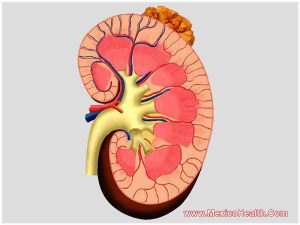 kidney-stone-removal