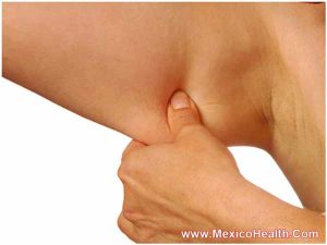 arm-lift-surgery-in-mexico