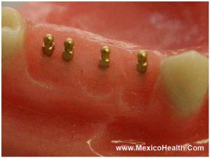 denture-implants-in-cancun-mexico_0