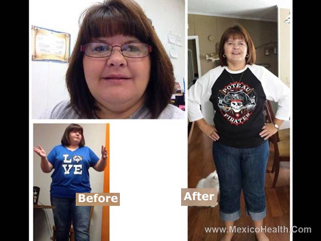 Weight Loss Surgery - Mexico Results