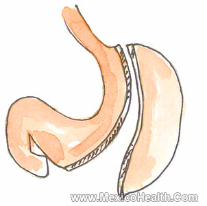 Vertical Sleeve Gastrectomy - Diagram